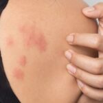 छालामा के कारणले हुन्छ एलर्जी? लापरवाही गरेमा ज्यान जान सक्ने जोखिम