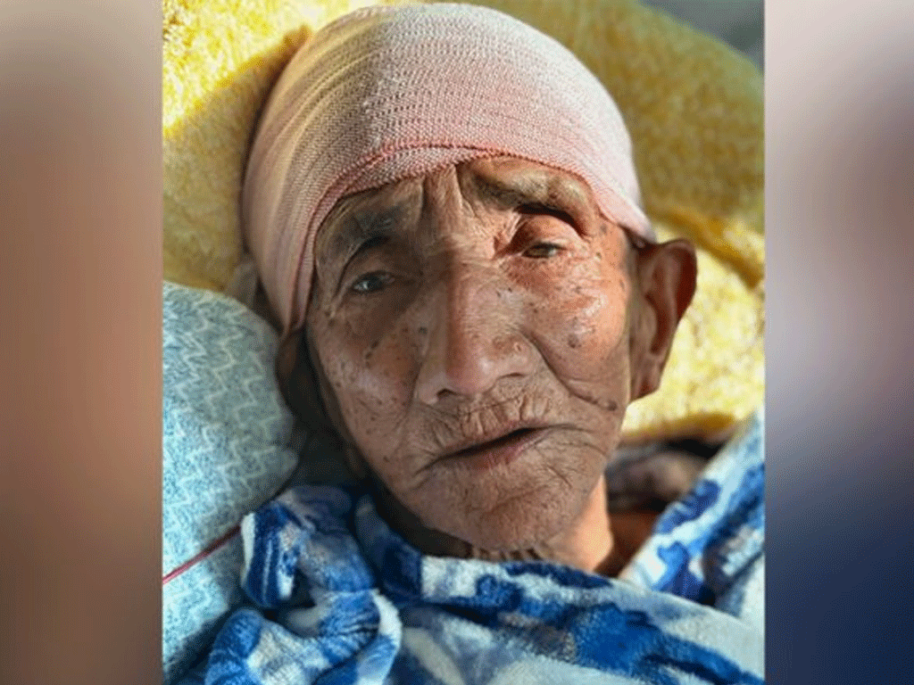 वीर अस्पतालमा १०३ वर्षीया वृद्धामा मस्तिष्कको शल्यक्रिया