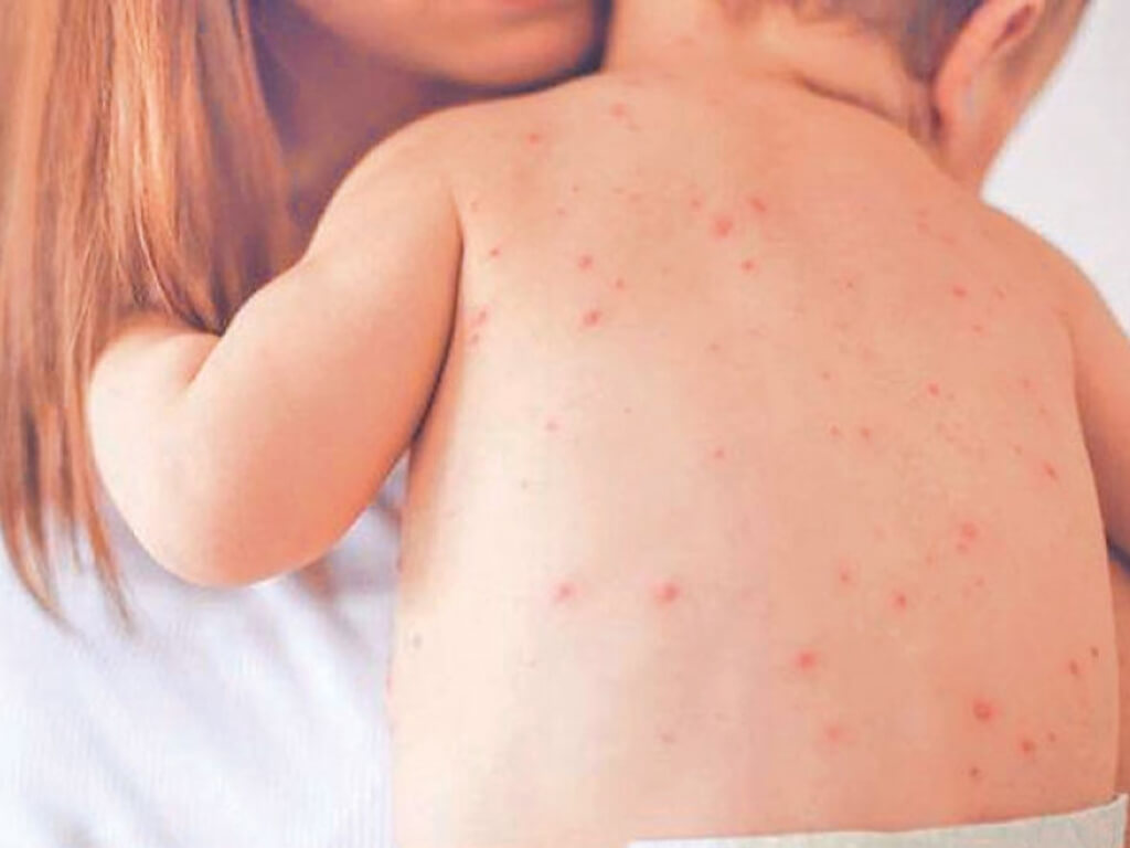 मलंगवामा फैलियो दादुरा संक्रमण